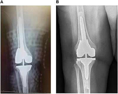 Comparing Revision Total Knee Arthroplasty Stems at a High-Volume Revision Center